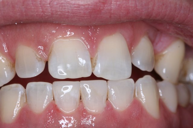 Lower Chipped Tooth After